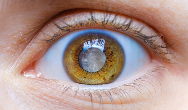 Cirugía de Catarata